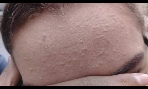 تجربتي مع حبوب تحت الجلد