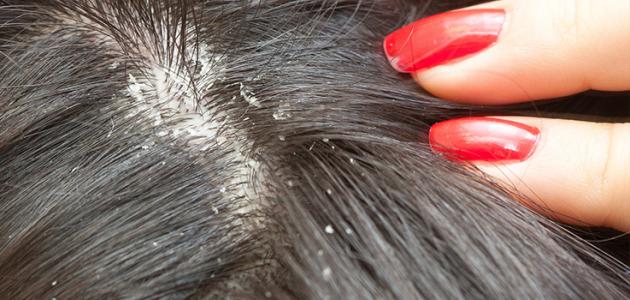 ما تفسير القمل في المنام للمتزوجة لابن سيرين