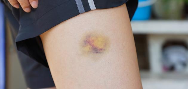 ما تفسير حلم كدمات في الفخذ في المنام لابن سيرين