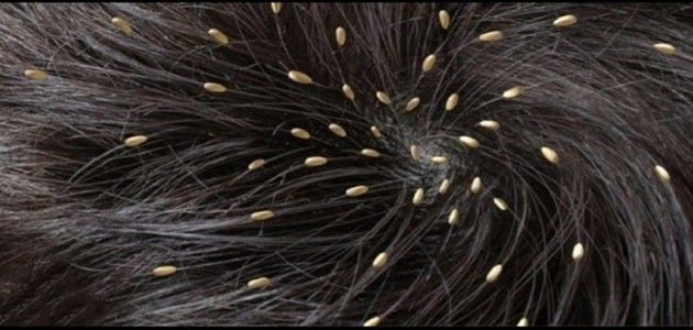 تعرف على تفسير حلم القمل في المنام لابن سيرين