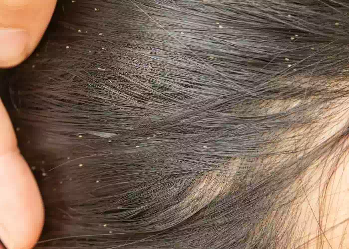 ما هو تفسير الحلم القمل في الشعر في المنام لابن سيرين