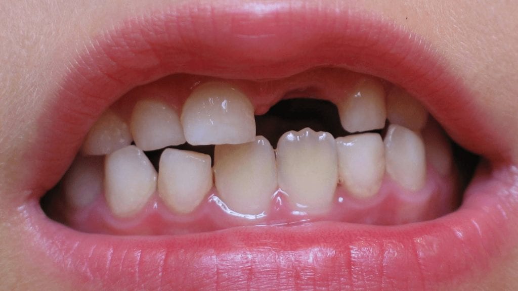 اعرف أكثر عن تفسير رؤية سقوط الأسنان في المنام ابن سيرين