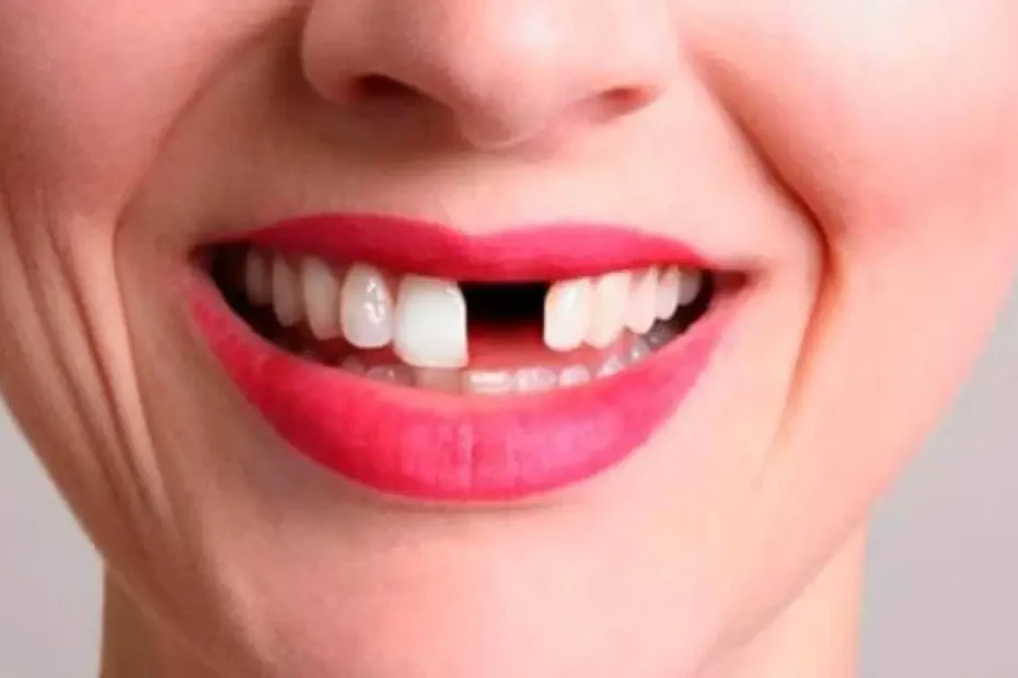 ما هو تفسير الحلم بسقوط سن واحد في المنام لابن سيرين