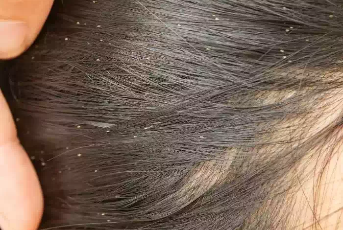 اعرف تفسير رؤية القملة في المنام لابن سيرين